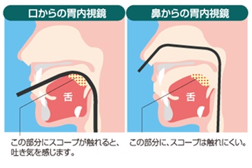 上部消化管内視鏡検査（胃カメラ）とは