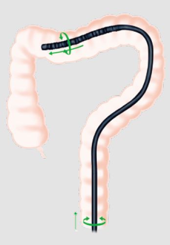 下部消化管内視鏡検査（大腸カメラ）とは